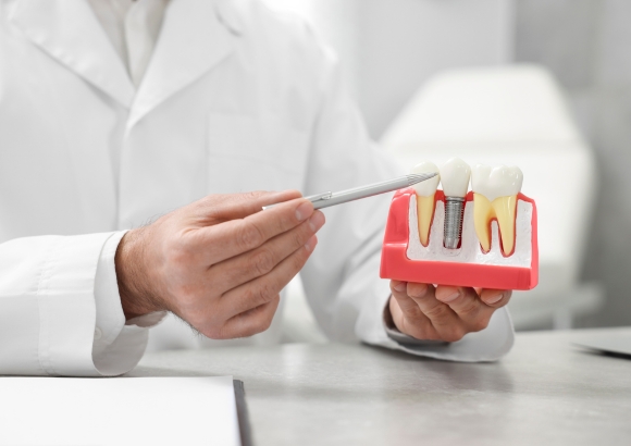 Dental Implants Dental Implants