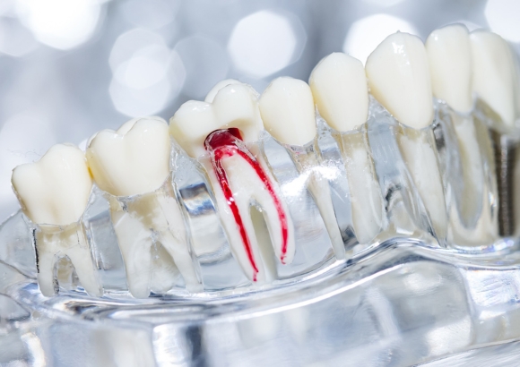 Root Canal Treatment Root Canal Treatment