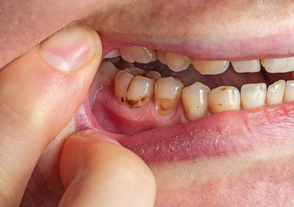 Tooth Decay Tooth Decay