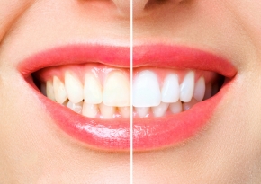 Add a subheading (290 x 205 px) Teeth Whitening