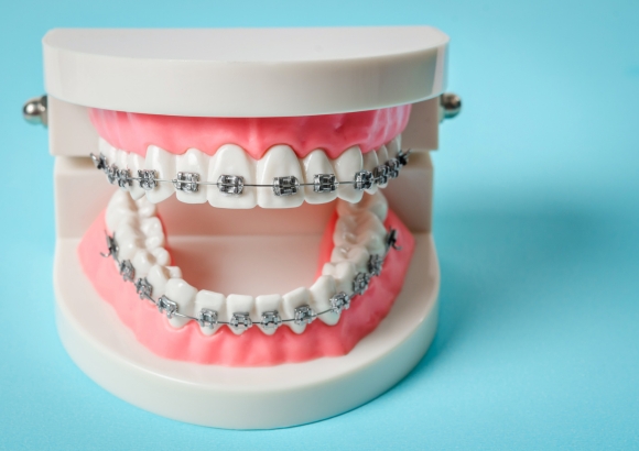 teeth-braces teeth-braces